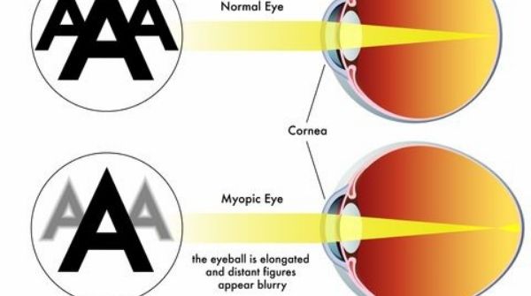 Aged people get blurred vision due to thinning of the macula & name of disease is age-related macular degeneration.
