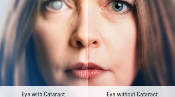 The Cloud formation in the lens is called a cataract and it is a very common problem existing across the world.