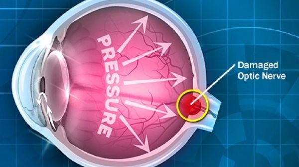 Glaucoma is caused due to build-up of pressure and symptoms of eye will be pain, blurred vision, etc.