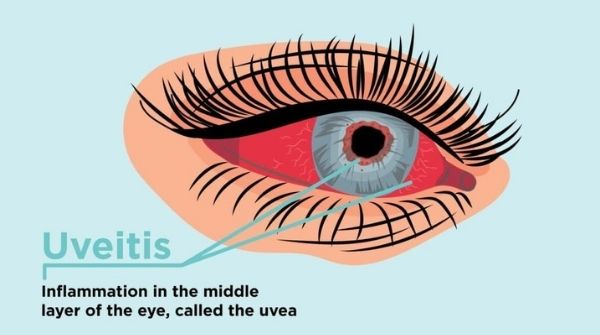 Causing inflammation in the middle layer called uvea, hence the name of eye disease is uveitis.