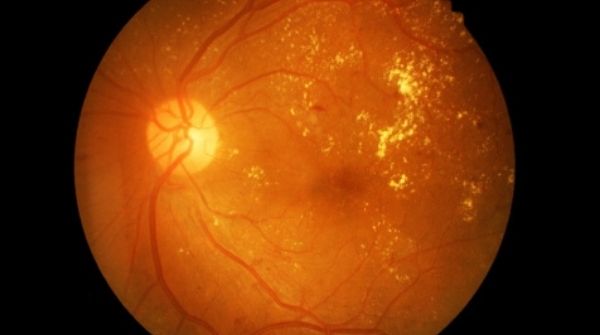 Get to know about the stages of Diabetic Retinopathy.