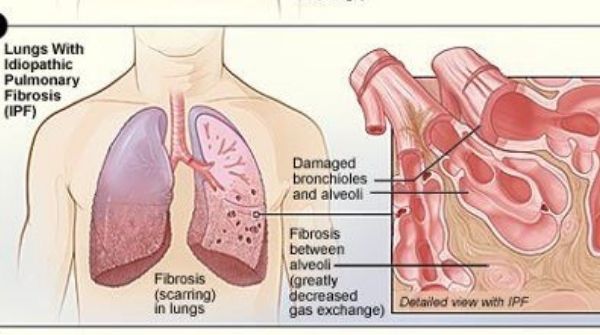 Pulmonary fibrosis will cause scarred and damage to the lung's tissue which can lead to death.