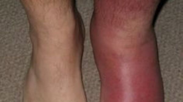 Cellulitis is a type of skin allergy is occurred by a bacterial infection that causes inflammation & redness in skin.