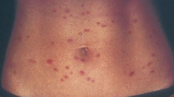 The meaning of this swimmers itch skin rash, is it causes the infection by waterborne parasites in infested water.