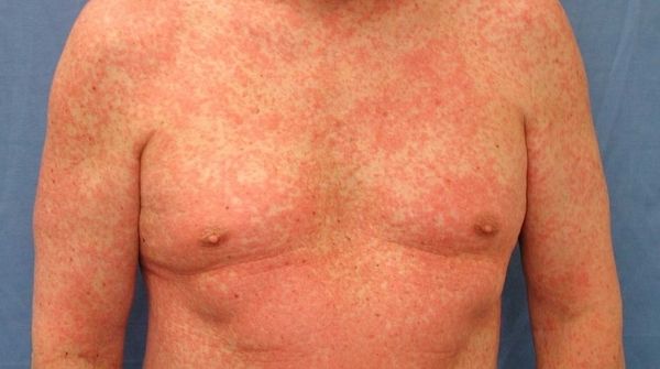 The meaning of the skin rash is, some medicines will produce rashes. Hence it is called as drug eruption.