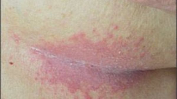 The skin-to-skin friction can create a moist & warm environment & cause this type of skin allergy in skin folds.