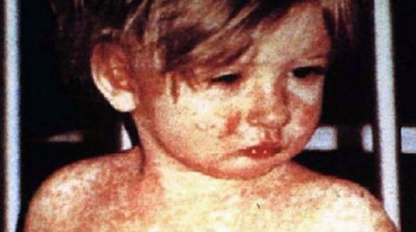 Measles is a highly contagious airborne viral infection & it will affect the respiratory system and spread in the body.