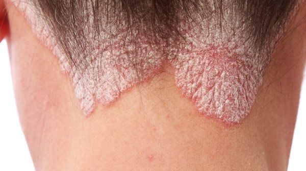 An autoimmune disease that mostly affects the knees, lower back, elbows, scalps, it can appear in any part of the body.