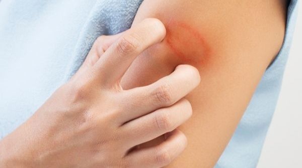 Different types of fungi will cause ringworm disease and it will form a ring-shaped structure, red, plaques in the body.