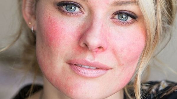 The meaning of this type skin rash is that blisters will turn out into the opened sores especially in the eyes, mouth, etc.