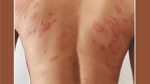 SLE causes butterfly-shaped type on the cheeks & the nose can be able to see in the affected person.