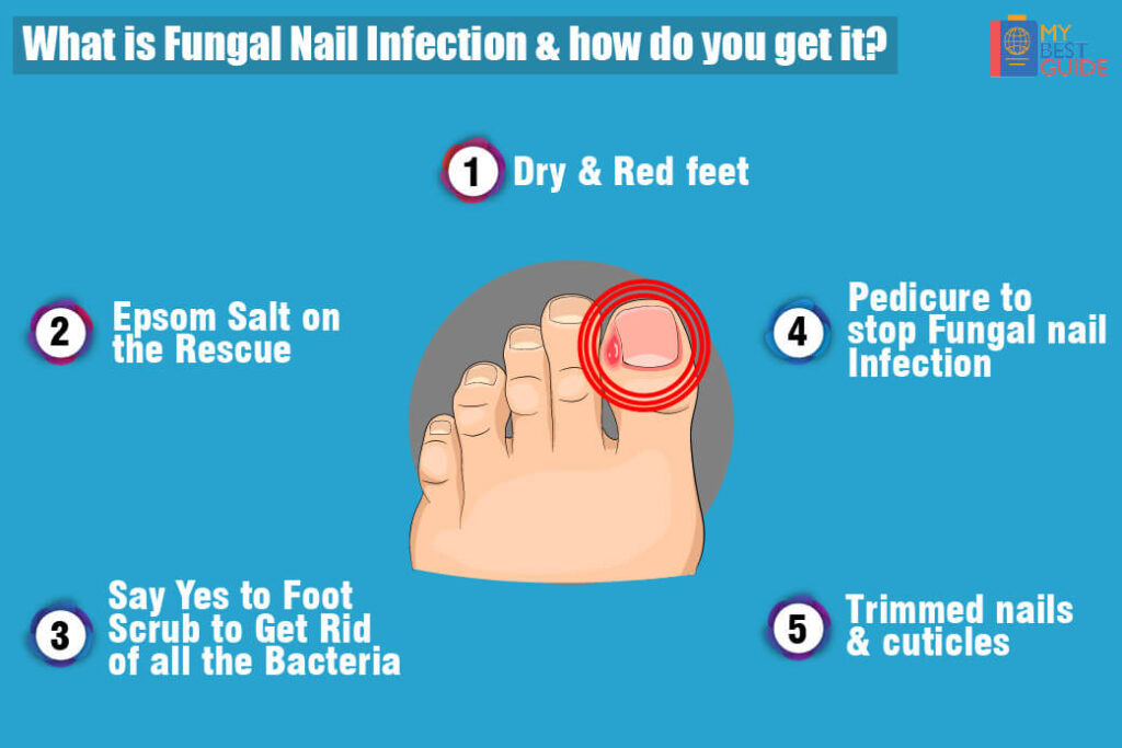 Fungal Nail Infection Treatment – Toenail or Toe Fungus